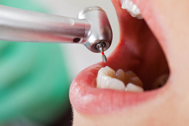 Best Emergency Wisdom Teeth Removal in Dyersville, IA